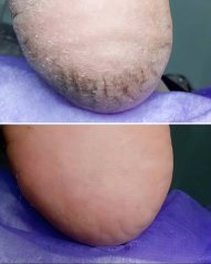 Laufwunder - Schrundena - na popraskané paty 75 ml